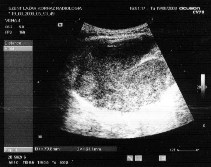 kiújulásmentes túlélés; MR = mágneses rezonancia; OS = teljes túlélés; PET-CT = pozitronemissziós tomográfia; RT-PCR = reverz transzkripciós polimeráz láncreakció; SMA = simaizomaktin; SS = sarcoma