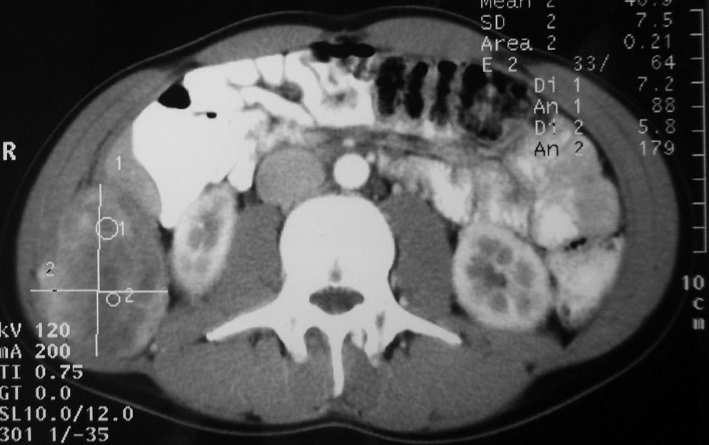 A szövettani diagnózis SS fibroticum (monofázisos) volt, a kimetszés nem épben történt (T2bNxM0).