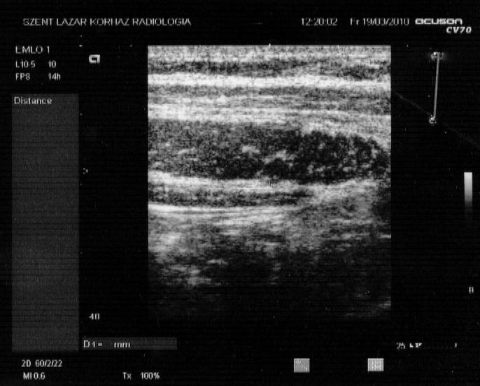 granulocytakolónia-stimuláló faktor (G-CSF) támogatással, majd ezt követően 60 Gy összgócdózisú