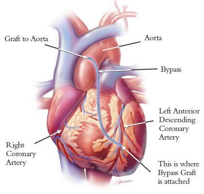 ISZB kezelése Coronaria bypass műtét (coronary artery bypass grafting CABG) Mellkas megnyitással járó nagyműtét A szűkületet áthidalják, jó