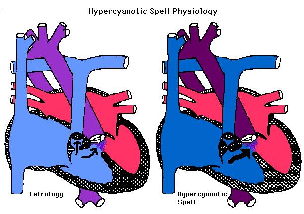 Cyanotikus roham Térd-könyök helyzet Oxigén Terápia Pipolphen