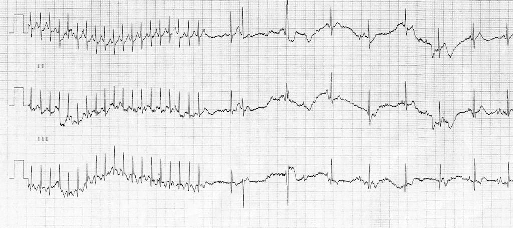 Paroxysmalis supraventricularis tachycardia Adenosine