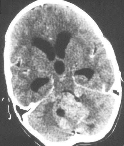 Hydrocephalus