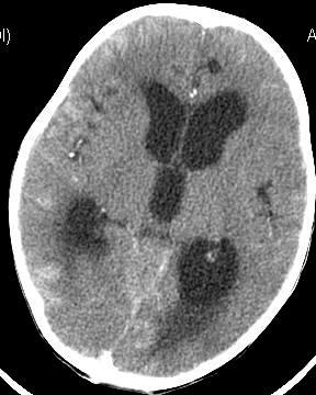 medulloblastoma