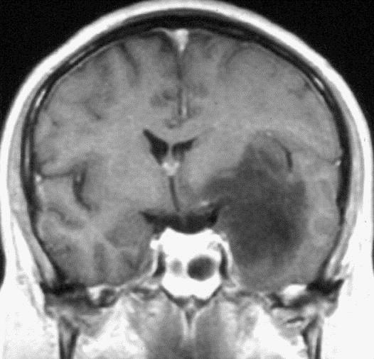 Astrocytoma