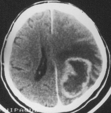 Glioblastoma