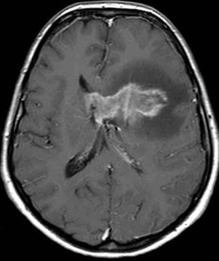 astrocytoma