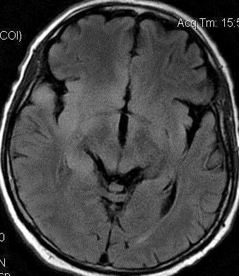 Encephalitis -