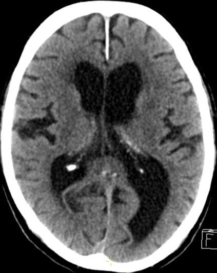 DEGENERATÍV ELVÁLTOZÁSOK Hydrocephalus