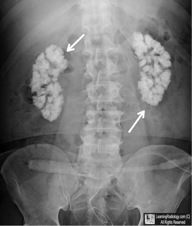 A nephrocalcinosis radiológiai tünetei hiperkalcémia krónikus következménye (kalcium sók lerakódása a vese (piramis) szöveteiben funkcionális zavarok) Hasi röntgen felvétel CT