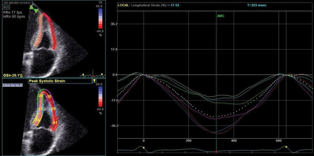 3. ábra A jobb kamra longitudinális funkció speckle-tracking echokardiográfiás vizsgálata. A szoftver a félautomata módszerrel bejelölt kamrafal mozgását képkockáról képkockára követi.