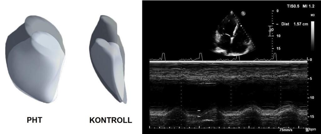 ábra Pulmonalis hypertensiós (PHT) beteg háromdimenziós jobbkamra-modellje egy egészséges kontrollal összehasonlítva végdiasztoléban és végszisztoléban.