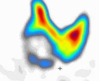 Tc-MDP: 600 MBq A