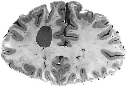 Felső motoneuron lézió Alsó motoneuron lézió Supra pontin (frontalis) Pontin központok Spinalis: detrusorsphincter dyssinergia Cauda equina, Pl. sacralis, n.