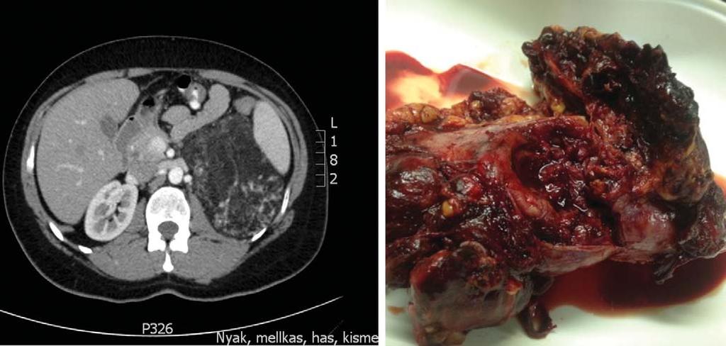 Az angiomyolipoma (AML) a vesében kialakuló, jóindulatú daganat, hamartoma, amely szövettanilag túlburjánzott atípusos erekből, simaizomból és zsírszövetből épül fel.