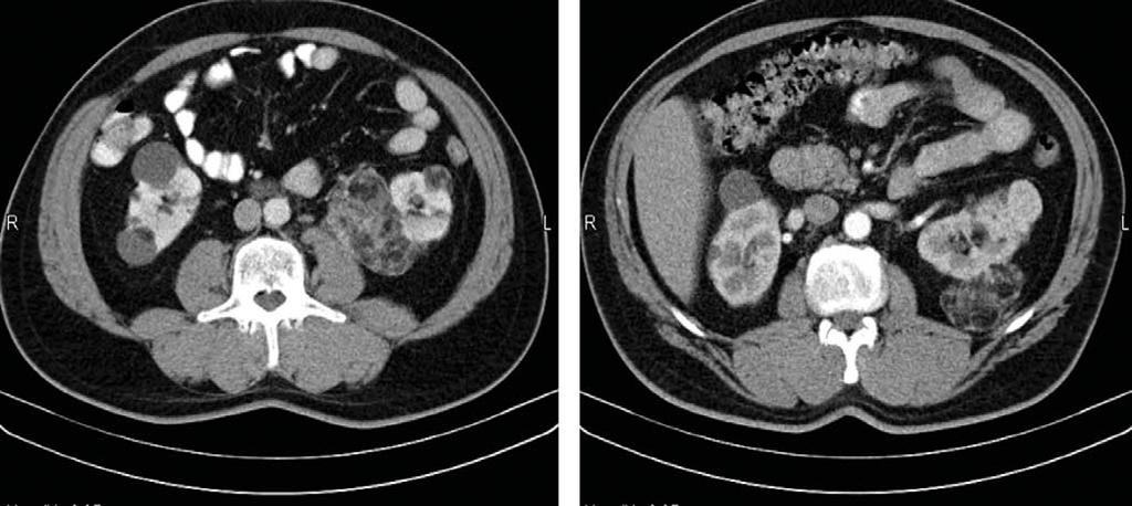 2. TÁBLÁZAT: A SPORADIKUS ÉS A SCLEROSIS TUBEROSA (TSC) KAPCSÁN KIALAKULÓ ANGIOMYOLIPOMÁK (AML) KLINIKAI JELLEMZŐINEK ÖSSZEHASONLÍTÁSA Jellemző TSC AML Sporadikus AML Életkor Fiatal (30 év) Középkorú