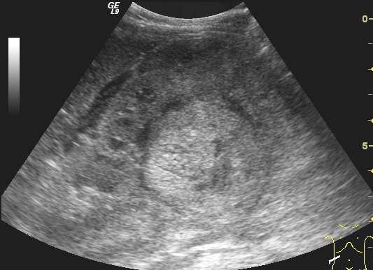 WILMS TUMOR Leggyakoribb vesetumor 1-5 éves kor Diagnosis: UH, CT