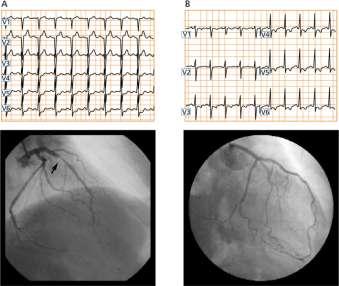 DIAGNOSZTIKA Terhelés okozta ischaemiás EKG változások szignifikáns atheroscleroticus LAD szűkület (A) és szignifikáns