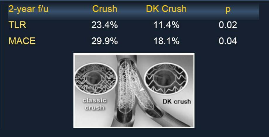 Double Kissing Crush: DKCRUSH-1 RCT: 312 beteg, 12 centrum, klasszikus crush vs.