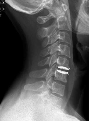 ábra: A nyaki porckorong protézis képe és röntgenképe Mi történik Önnel a műtét után? A műtét befejeztével még egy bizonyos ideig Ön a műtőben marad, megfigyelés céljából.