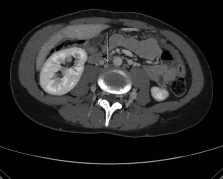 1. ábra Az 1. beteg axiális CTA-képe, amelyen a nyíl jelöli a krónikusan occludált vena cava inferiort 3. ábra A 2. beteg MR-képe. A nyíl a krónikus vena cava inferior occlusióra mutat 4. ábra A 3.