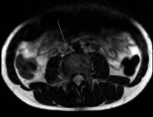 beteg coronalis síkú MR-felvétele, amelyen látható a vena cava inferior környezetében a kiterjedt vénás kollaterális hálózat elvégzett MR-vizsgálat már felvetette a VCI és a vena iliacák occlusióját