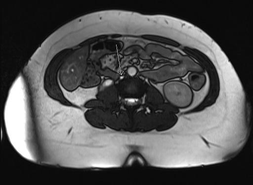 A panaszok perzisztálása miatt elvégzett CT-vizsgálat igazolta a subhepaticus VCI krónikus occlusióját és mindkét vena iliaca communis, interna és externa akut thrombosisát, kiterjedt vénás