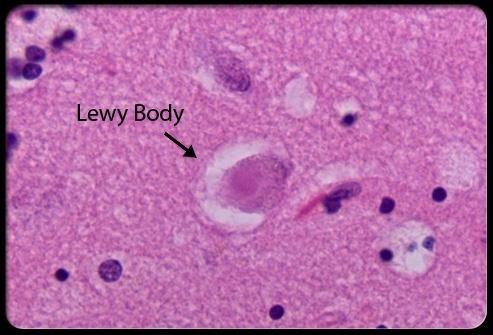 demencia Frederic Lewy (1885-1950) Parkinson-betegséghez társuló demencia (25-30%) 1 éves szabály!