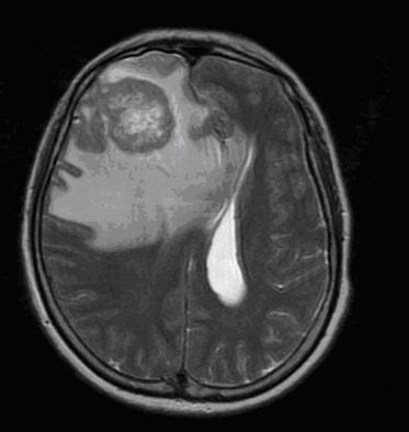 Kórlefolyás 11 nap múlva MRI; 14 nap múlva soliter metastasis műtéte; 1 napig utána confusus