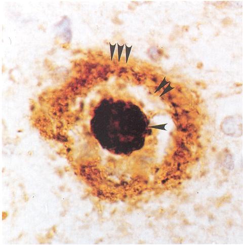 Neuropatológiai specifikum: kétféle kóros fehérje együttes előfordulása