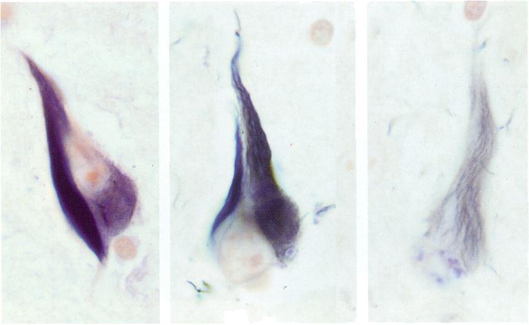 aggregáció: intercellularis Kórosan foszforilált τ-fehérje (1986):