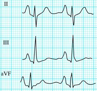 avf és V 1 elvezetésben) A Ppulmonaleakut pulmonális embóliában iselőfordul Ideje <