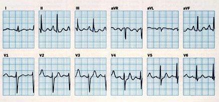 Normális P hullám Jobb pitvari megnagyobbodás Bal pitvari megnagyobbodás Jobb pitvariabnormalitás, a QRS +70 0 frontálisan és kb.