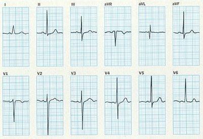 08 sec 20 o frontális, 40 o poszterior; a Thullám+30 o, 80-90 o anterior P hullámnormális, PR távolság 0.17 sec QRS 0.