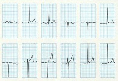 grádiens) normális marad ( Normális: 0-90 o között) U hullám előfordulhat mellkasi elvezetésben Megjegyzés: Hosszú ideig fennálló bal kamrai