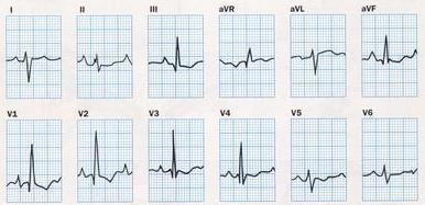 Ismételtpulmonálisembolizáció Jobb és bal pitvari eltérések jelen lehetnek QRS ideje 0.