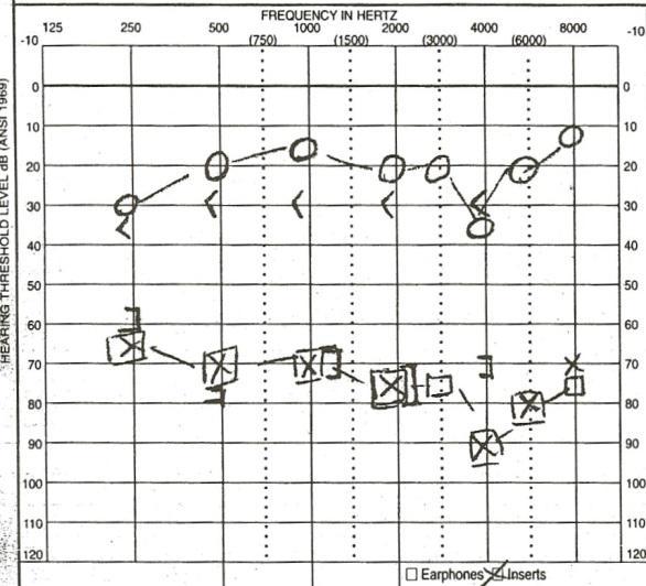 Best hearing threshold at FREQmax Kapcsolat a tinnitus súlyossága és a hallásküszöb között Tinnitus symptom severity and best