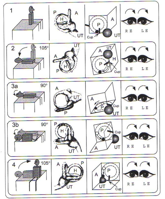 cupulolithiasis, Schuknecht,