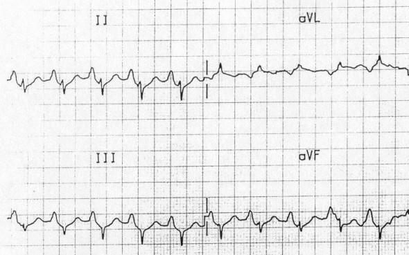 P pulmonale