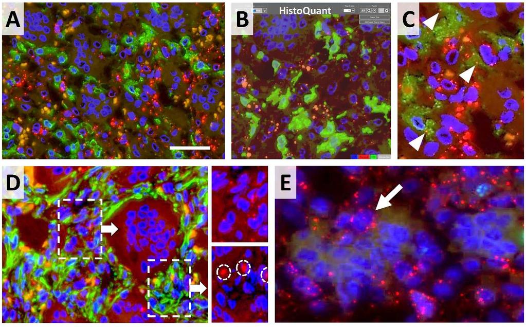 21. ábra. A Cx43 fehérjét termelő sejttípusok meghatározása kettős immunfluoreszcens reakcióval óriássejtes csonttumorban (GCTB).