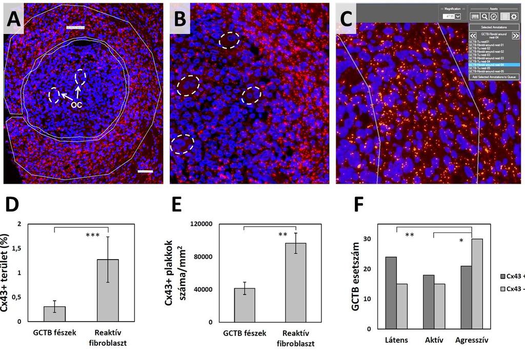 23. ábra. A Cx43 fehérje immunfluoreszcens detektálása és a Cx43 fehérjeszint klinikopatológiai korrelációja óriássejtes csonttumorban (GCTB).