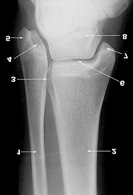 1. Fibula 2. Tibia 3. Incisura fibularis tibiae 4. Fossa malleoli 5.