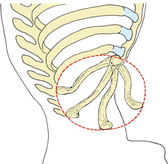 (Axis sagittalis) retractio