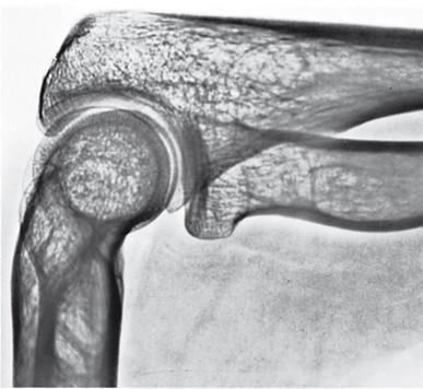 Articulatio cubiti Három csont (humerus, ulna, radius) által alkotott komplex ízület, ún.