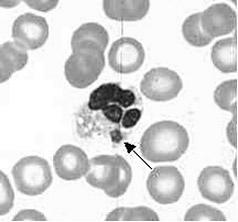 Hematológiai és klinikai kémiai eltérések thrombocytopaenia (A