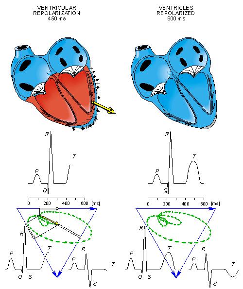 AZ EKG HULLÁM LÉTREJÖTTE A SZÍVCIKLUS SORÁN 3. AZ EKG HULLÁM LÉTREJÖTTE A SZÍVCIKLUS SORÁN 4. The depolarization front continues propagation along the left ventricular wall toward the back.