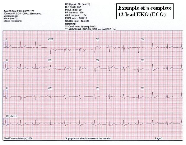 This seems paradoxical, but even though the epicardiumis the last to depolarize, its action potential durations are relatively short, and it is the first to recover.
