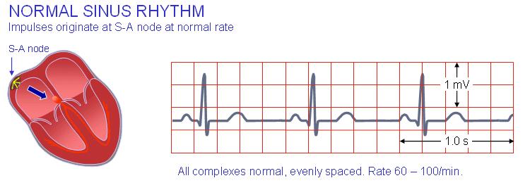 bradycardia.