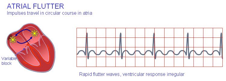 polarity, and the PQinterval will also