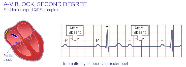 1st degree: constant PR, >0.